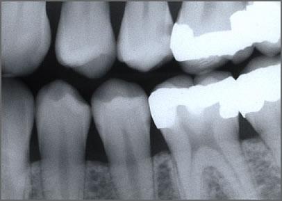 metodou, prosvětlen tlení zubu a rentg.. snímek mek. Příznaky znaky zubního kazu Subjektivní příznaky ZK závisz visí na lokalizaci a hloubce kazu.