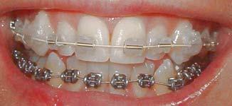 Do zámečků je vložen drát, který mám tvar plánovan novaného ideáln lního zubního oblouku. Dráty ty se v průběhu léčby l vyměň ěňují a posunují zuby na správn vné místo.