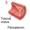 Ateromy se mohou dále zvětšovat. Ve fibrózních plátech najdeme především velké množství proliferujících buněk hladkých svalů a mikrofágů v různém stupni přeměny v pěnovou buňku.