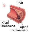 Z fibrózních krystalů masivní kalcifikací a především následně těžkými degenerativními změnami (ulcerace, ruptura) vznikají komplikované léze, které se pak stávají místem adherence a agregace