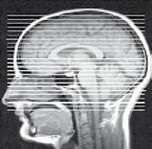 3.3 Rozlišení mezi PML a relapsem RS pomocí MRI Standardní protokol MRI nejlépe bez a s kontrastní látkou pro sledování pacientů léčených TYSABRI je navržen tak, aby poskytoval nejlepší možné snímky