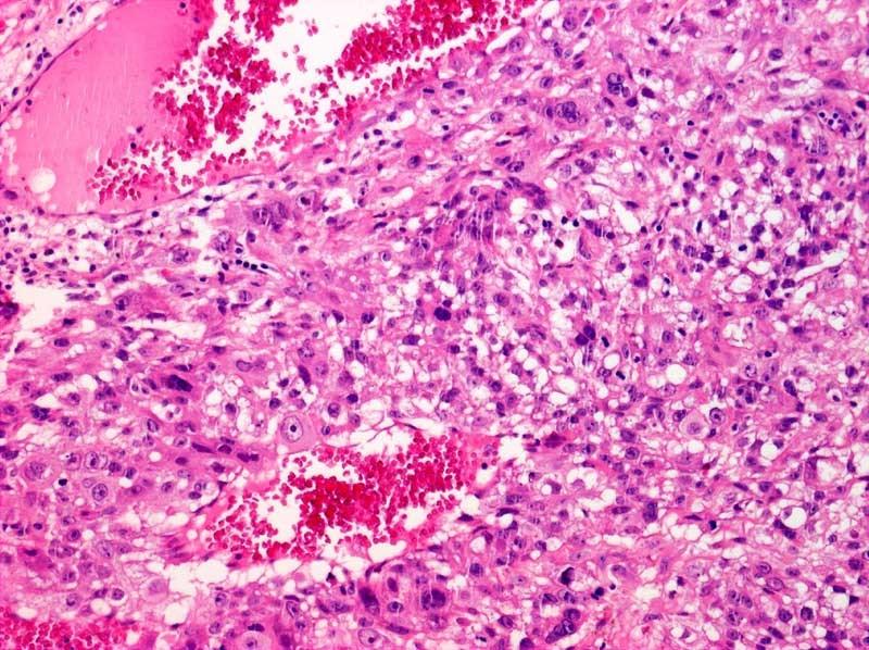 reprezentuje pouze endoderm či ektoderm, pak by měl být tumor označován jako tzv. monodermální teratom.