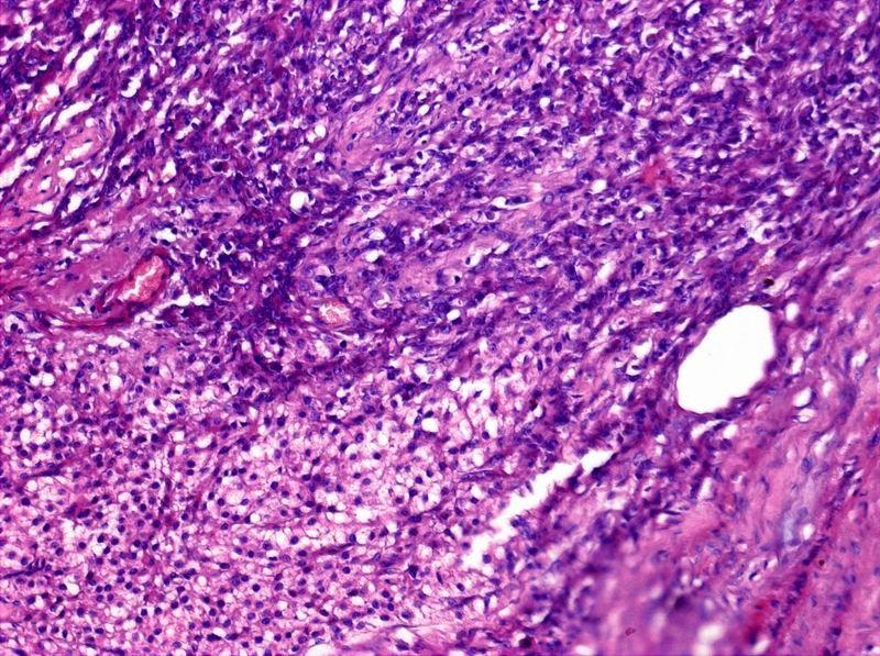 Obr. 12 Maligní nádor z Leydigových buněk 31 b. Nádory ze Sertoliho buněk Nádory ze Sertoliho buněk (NSB) tvoří méně než 1% všech nádorů varlat. Vyskytují se ve všech věkových kategoriích.