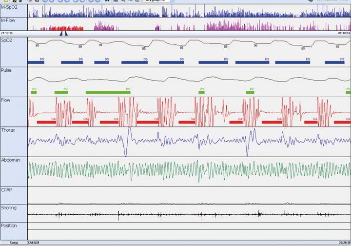 Obr. 1. Pětiminutová část záznamu limitované polysomnografie; v 1. řádku je zobrazena saturace hemoglobinu kyslíkem, kde modré obdélníky oznažují poklesy saturace, 2.