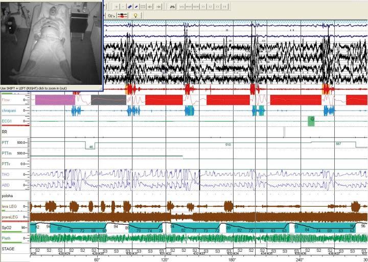 Obr. 3. Pětiminutová část záznamu kompletní videopolysomnografie; v levém rohu záznamu je na obrazovce pacient, který je snímán kamerou v infračerveném světle.