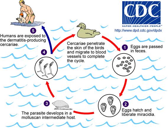 Cerkariová dermatitida Cerkariová