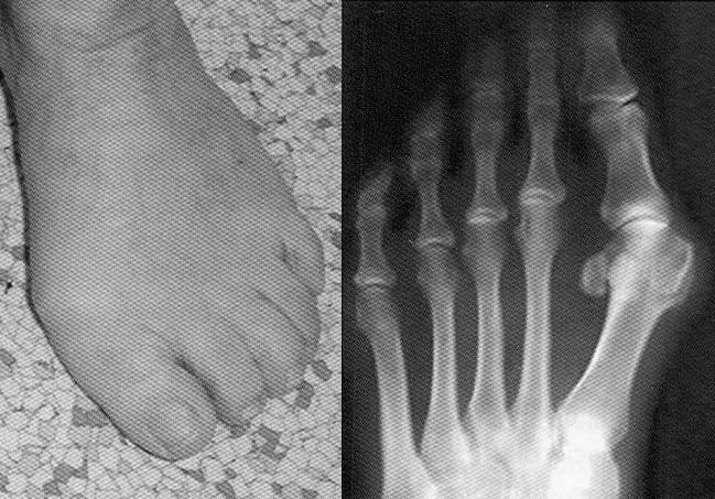 5.4 Vbočený palec Vbočený palec (hallux valgus) je nejčastější deformitou prstu na noze v dnešní populaci.