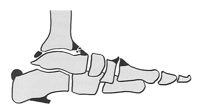 5.8 Další deformity prstů nohy Deformity prstů nohy jsou jedním z nejčastějších získaných vad nohy.