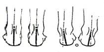 Je tedy vbočená směrem ke střední rovině a nohy mají při této deformitě typickou podobu písmene X.