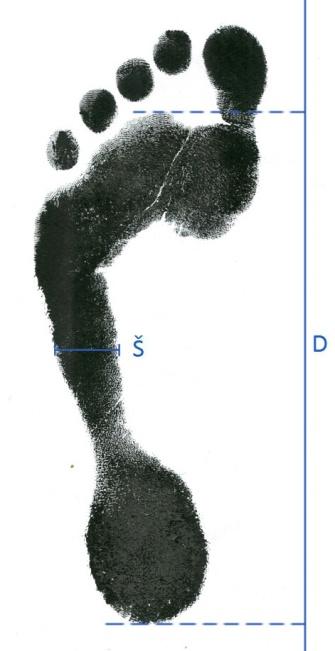 Vysoká noha Normální noha Plochá noha I. II. III. 0,00 0,25 (V) 0,26 0,45 (N) 0,46 0,49 (P1) 0,50 0,75 (P2) 0,76 1,00 (P3) Obrázek 25: Metoda indexu Srdečný.