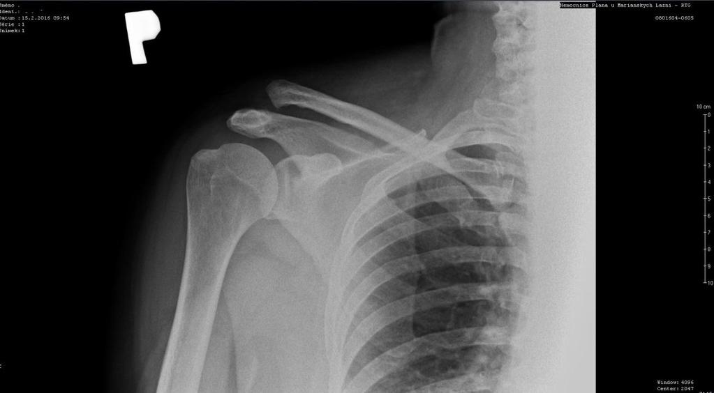 5.2 Kazuistika č. 2 Žena, 65 let Anamnéza: Pacientka byla přijata 15. 2. 2016 na kliniku Ortopedie a traumatologie po pádu ze schůdků při věšení záclon.