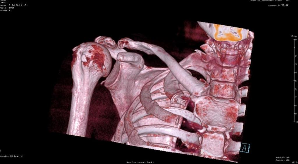 Obrázek 12: CT vyšetření, 3D