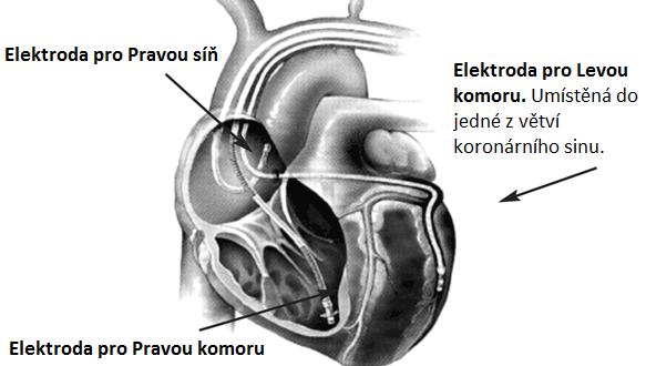 3 Postup výkonu Obrázek 39 - VCG modul Nyní bude popsáno, jak probíhá implantace BIV ICD generátoru pro resynchronizační terapii. Skládá se z několika kroků, které jsou popsané ve svých kapitolách.