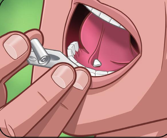 . Tabletu si vložte pod jazyk na nejnižší místo a počkejte, dokud se zcela nerozpustí.. Tabletu nesajte, nežvýkejte ani nepolykejte. Mohlo by to opozdit nebo snížit úlevu od bolesti.
