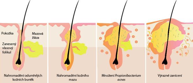 JAK AKNÉ VZNIKÁ? Akné je zánětlivé onemocnění mazových žláz a vlasových folikulů. Na kůži jsou malé otvory póry, které se nazývají vlasové folikuly a které uvolňují sebum neboli kožní maz.