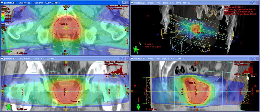 Obrázek 3: Ozařovací plán technikou IMRT Transverzální, koronární a sagitální řez se zobrazením dávkové distribuce a