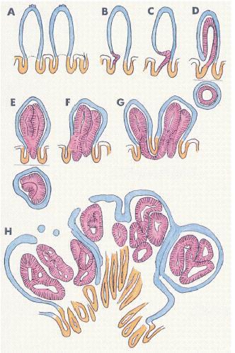 Tvorba adenomatózních polypů u FAP A.