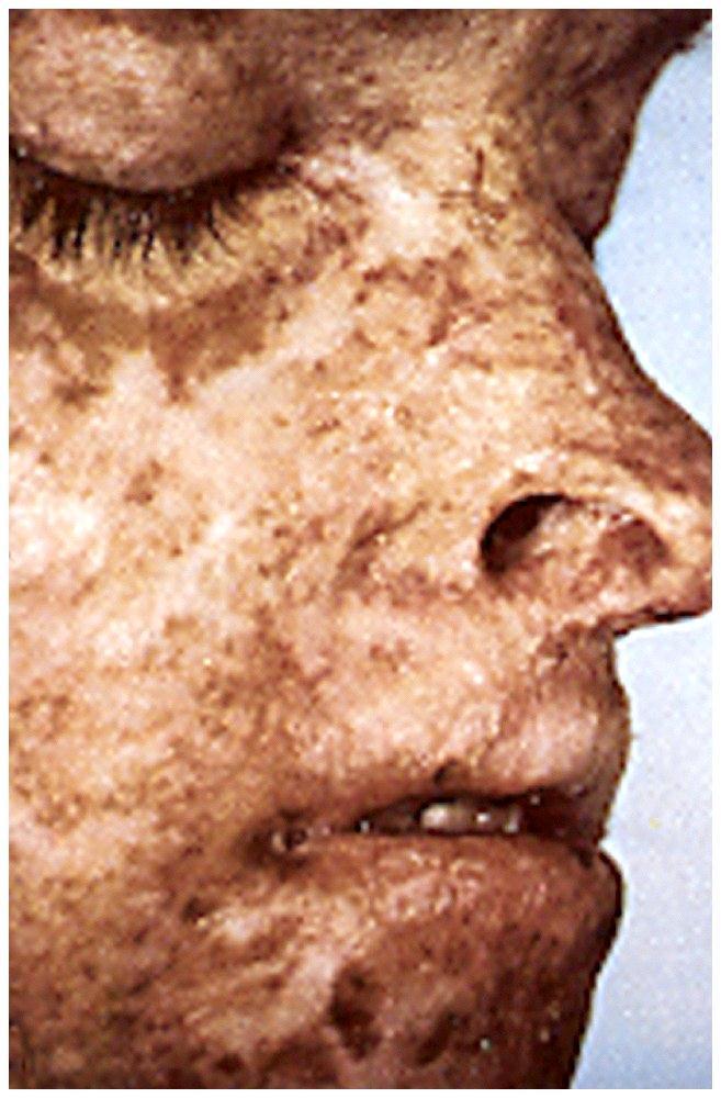Xeroderma pigmentosum 90% nádorů kůže se objevuje na obličeji, krku, a hlavě - místech nejvíce vystavených slunci.