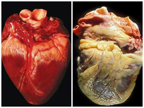 Kardiovaskulární změny obezita je nezávislý rizikový faktor centrální distribuce tuku Vyšší nároky na práci srdce + nároky fetoplacentární jednotky srdeční arytmie: náhlá