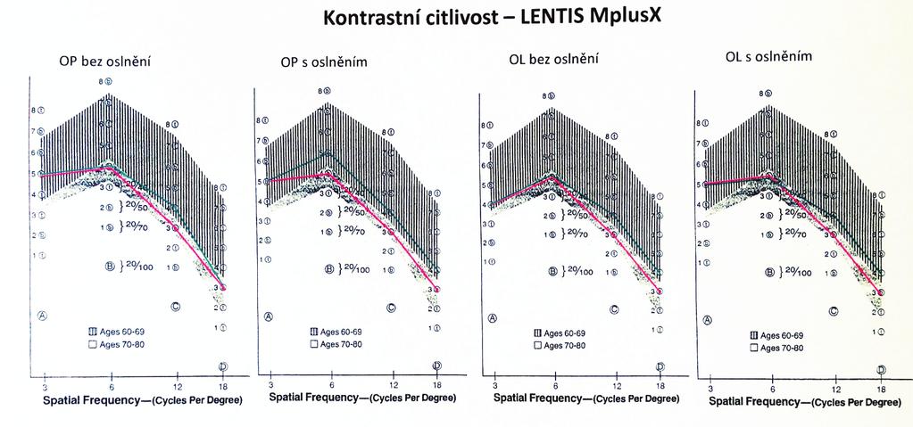 úhlový stupeň Průměrná hodnota předoperační monokulární NZO do blízka ve skupině A byla Jaeger (J.) č. 12,82 ± 4,16; ve skupině B J. č. 12,73 ± 3,99.