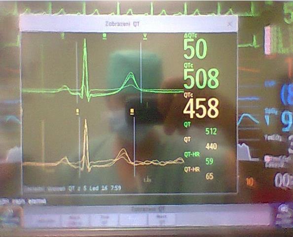 5.1.2016: muž, 67 let, aorto-bifemorální bypass kombinovaná anestezie: