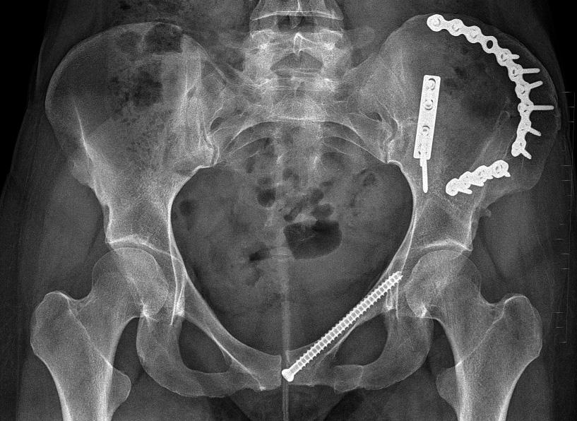 zlomeniny horního raménka stydké kosti pomocí distraktoru na Schanzových šroubech zavedených ipsilaterálně supraacetabulárně a kontralaterálně do lopaty kyčelní kosti, c peroperační CT sken v