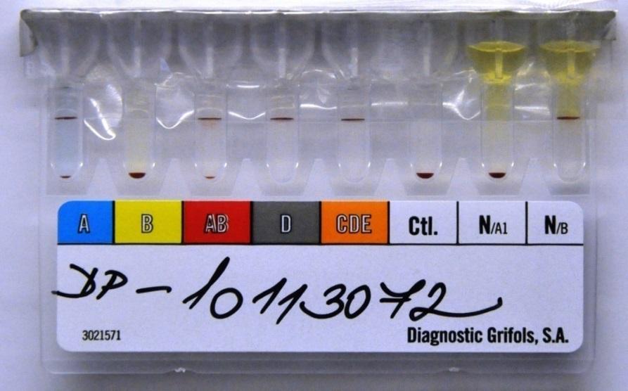 MOŽNÉ KOMPLIKACE PŘI MASIVNÍ TRANSFUZI 1. Akutní hemolytická potransfuzní reakce - AB0 systém 2. Pozdní hemolytická potransfuzní reakce - Kell, Duffy 3.