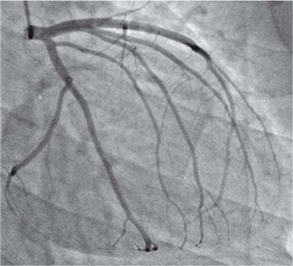 Koronární oběh Koronární angiografie