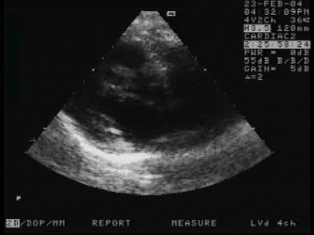 Echocardiography in arrhythmia TTE as first choice: LV size, contractility? LVEDP, preload catecholamines? Valves: MS, MR, AS sig.? Dilated LA? Spont.
