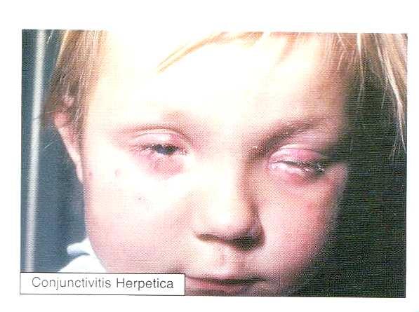 Opakovaná infekce se manifestuje jako herpes labialis (viz. obr.