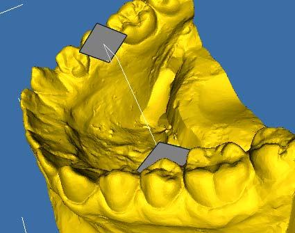 vpravo: změření vzdálenosti mezi dvěma implantáty) Obr.