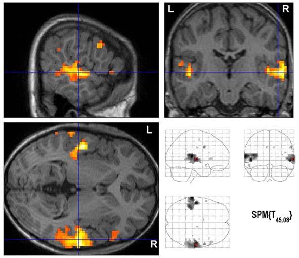 Zkoumání vlivu nepřesností v experimentální stimulaci u fmri experiment ze dvou různých stavů: jeden srovnávací, např. klid, a jeden cílový, např. pohyb končetinou.