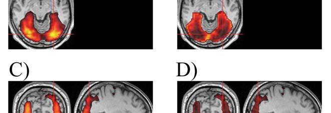 Zkoumání vlivu nepřesností v experimentální stimulaci u fmri Na uvedených příkladech je patrný rozdíl v mapách maximální přípustné nepřesnosti stanovené dle PNv a PNd.