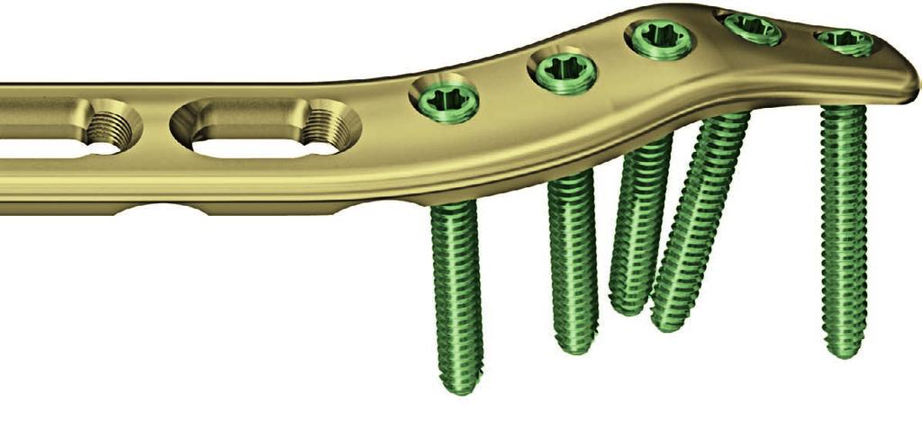 LCP extraartikulární dlaha na distální humerus. Anatomicky tvarovaný úhlově stabilní fixační systém pro extraartikulární zlomeniny distálního humeru.