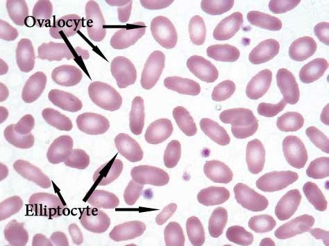 Eliptocytóza Autozomálně dominantní choroba Typický elipsoidní tvar červených krvinek Většina pacientů bez příznaků, 10 % případů anémie, se vyskytuje v endemických oblastech malárie, především v