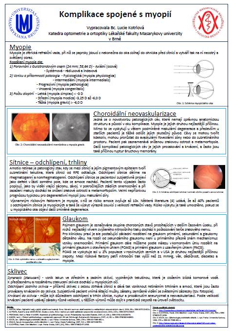 myopia astigmatizmusa van