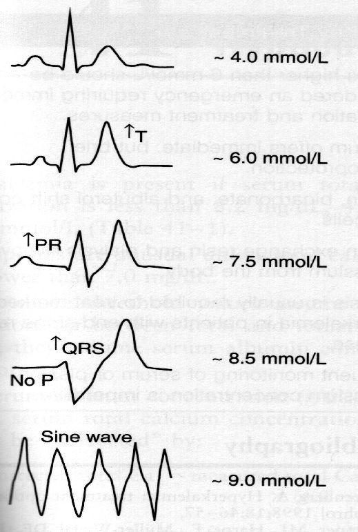 Hyperkalemie hemolýza rabdomyolýza anurie, akutní renální selhání (ARF) Acidóza Th: CAVE intrakardiální blokáda (diastolic arest) / komorová fibrilace