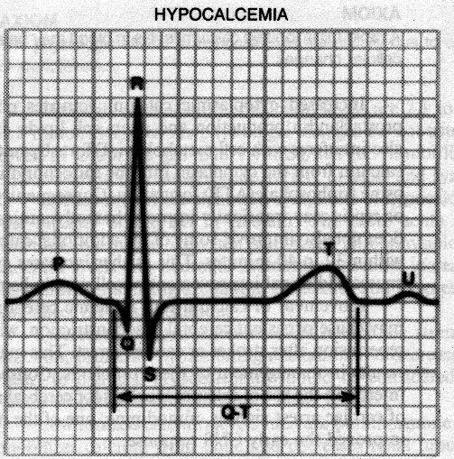 poruchy Ca++ Hypocalcemia Respiratory
