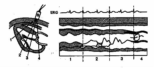 Sonografie M-zobrazení Jednorozměrné statické B-zobrazení ukazuje pohyby odrážejících tkání. Druhým rozměrem je u této metody čas. Statická sonda zachycuje odrazy od pohybujících se struktur.