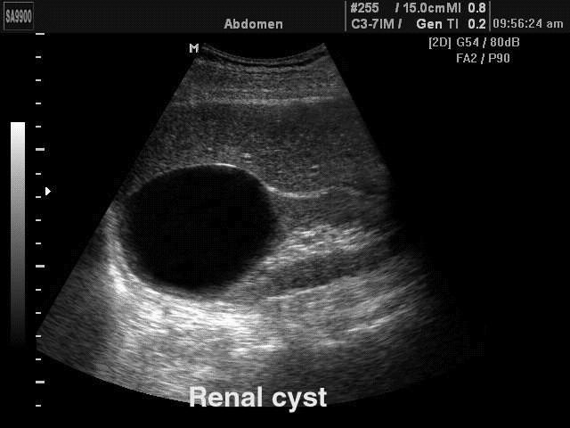 Hyperechogenní oblast pod cystou (nízký útlum