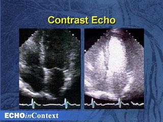 Sonografie Echokontrastní prostředky - použití Zesílené