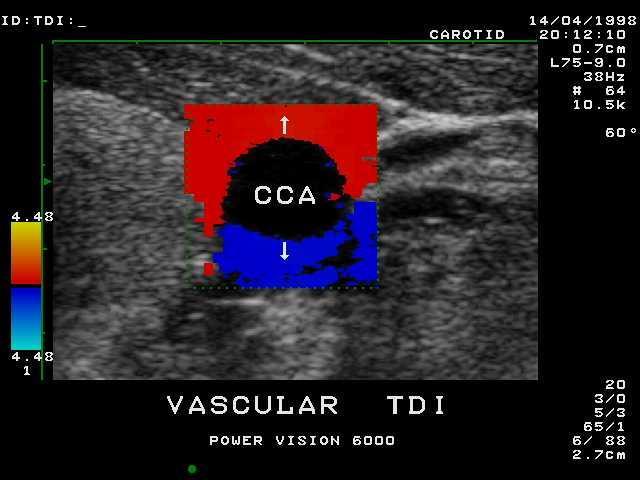 Dopplerovské měření toku Barevné zobrazení tkání (TDI - Tissue Doppler Imaging) Barevné kódování informace