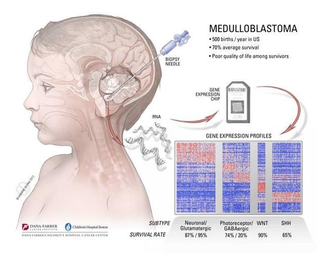 Meduloblastom (MD) - embryonální neuroektodermální tumor mozečku - agresivní, metastázující - postihuje hlavně děti - ročně v ČR onemocní 10-12 dětí Převzato z http://vector.