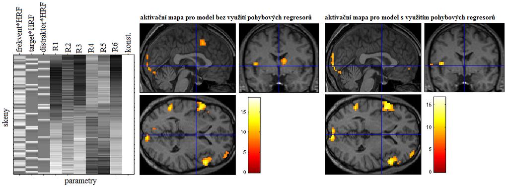 Obrázek 17: Efekt ovlivnění BOLD signálu pohybovými artefakty [23] Na obr. 18 je ukázka aktivačních map, na kterých je možné pozorovat vliv zahrnutí pohybových parametrů do GLM.