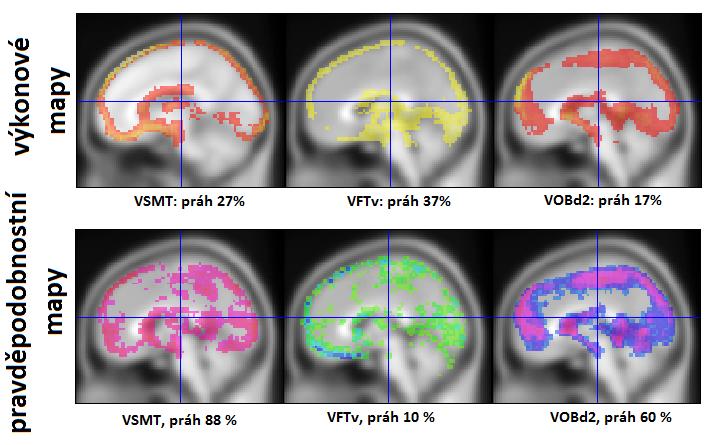 34 zobrazujícím sagitální řezy pravděpodobnostními a výkonovými mapami je ukázán projev pohybového artefaktu v oblasti kalózního tělesa a na okrajích mozku. Následující obr.