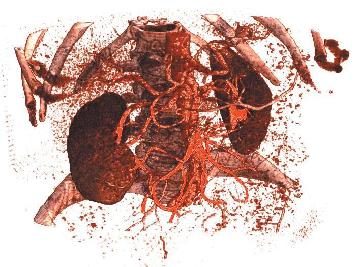 Obr. 2-10: Zobrazení pacientových ledvin Zdroj: [9] Podobně jako v medicíně se využívá ray tracingu k vizualizaci nasnímaných dat lidského těla, tak podobně je využíván i ve