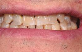 využití těchto hmot. <<< Obr. 1 Preparovaný a dostavěný zubní pahýl Obr.