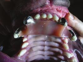 ODBORNOST ortodontický aparát před poškozením. ORTODONCIE VADNÉHO POSTAVENÍ ŠPIČÁKŮ Nejčastější je tzv. lingvoverze mandibulárních špičáků.