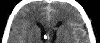 aneuryzma