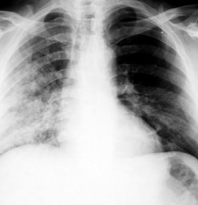 Bronchopneumonie www.szote.